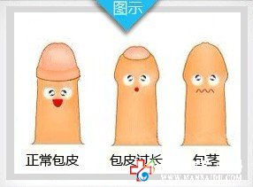 男人包皮过长该如何解决？—石狮男科医院