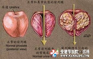 前列腺偏大怎么治疗_石狮京都医院