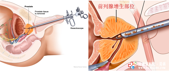 患了前列腺增生不治疗危害大吗?