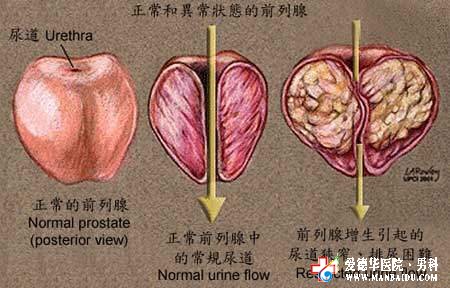 前列腺增生出现血尿怎么办？—石狮京都医院