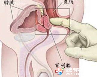 前列腺炎不治可诱发不育症 石狮京都医院