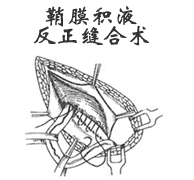 鞘膜积液反正缝合术