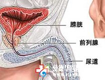 得了膀胱结石怎么办