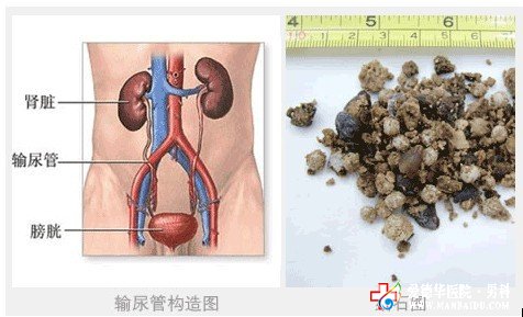 男性肾结石是怎么形成的