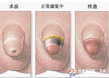 石狮男科医院微创包皮手术效果好吗