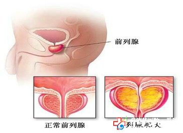 治疗前列腺增生什么技术可以治愈？—石狮男科医院