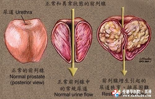 石狮专治前列腺增生医院—石狮京都医院