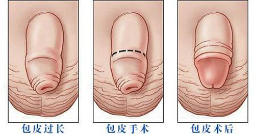 九江市治疗包皮过长的方法